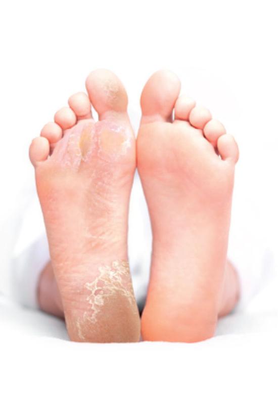 Baby Foot Exfoliation Foot Peel